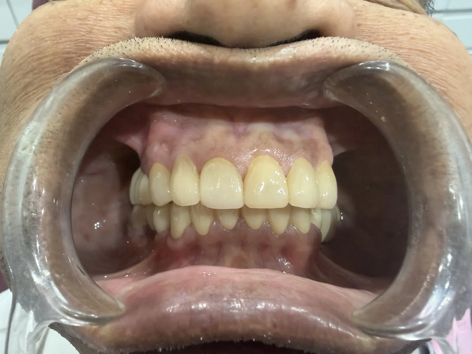 After: Front view, Case 1 · Full-Mouth Rehabilitation