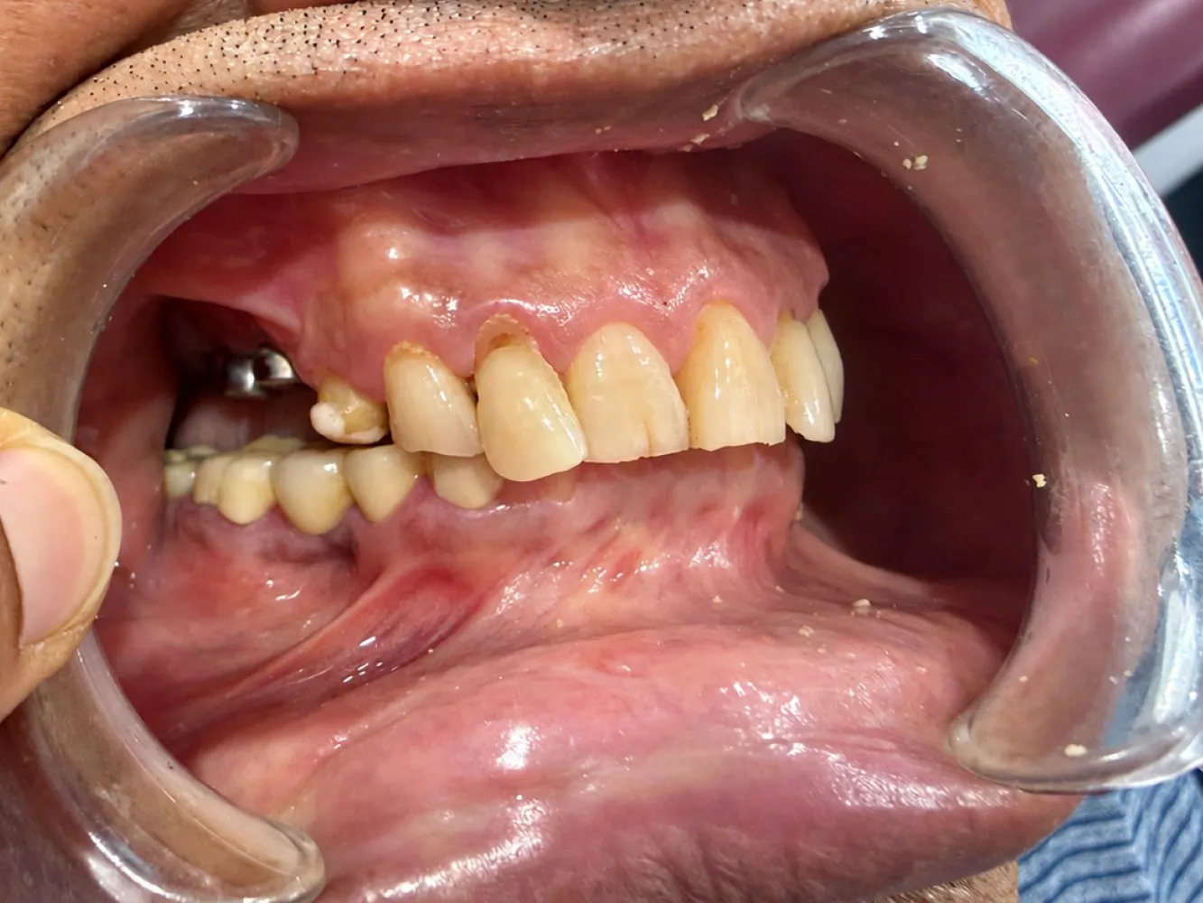 After: Left side, Case 1 · Full-Mouth Rehabilitation