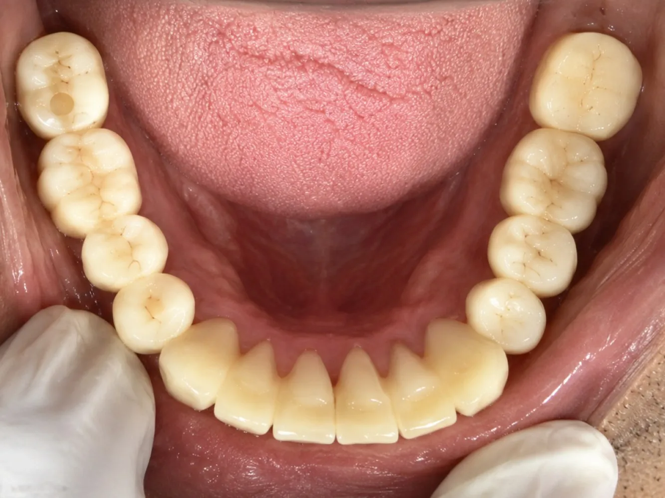 After: Lower jaw, Case 1 · Full-Mouth Rehabilitation