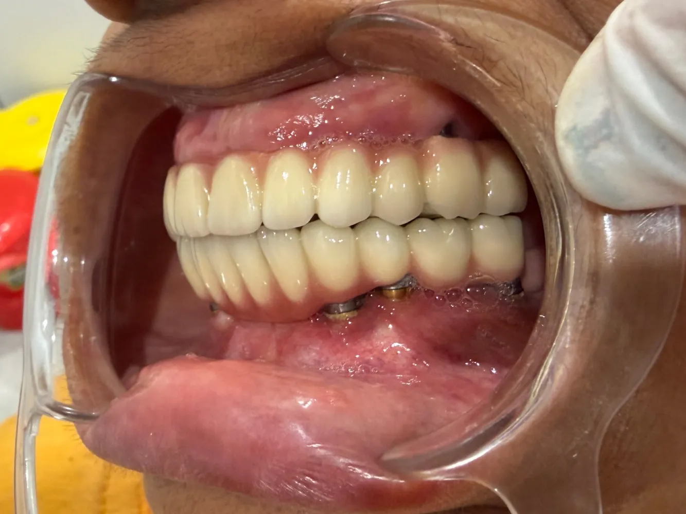 After: Right side, Case 2 · Full-Mouth Rehabilitation