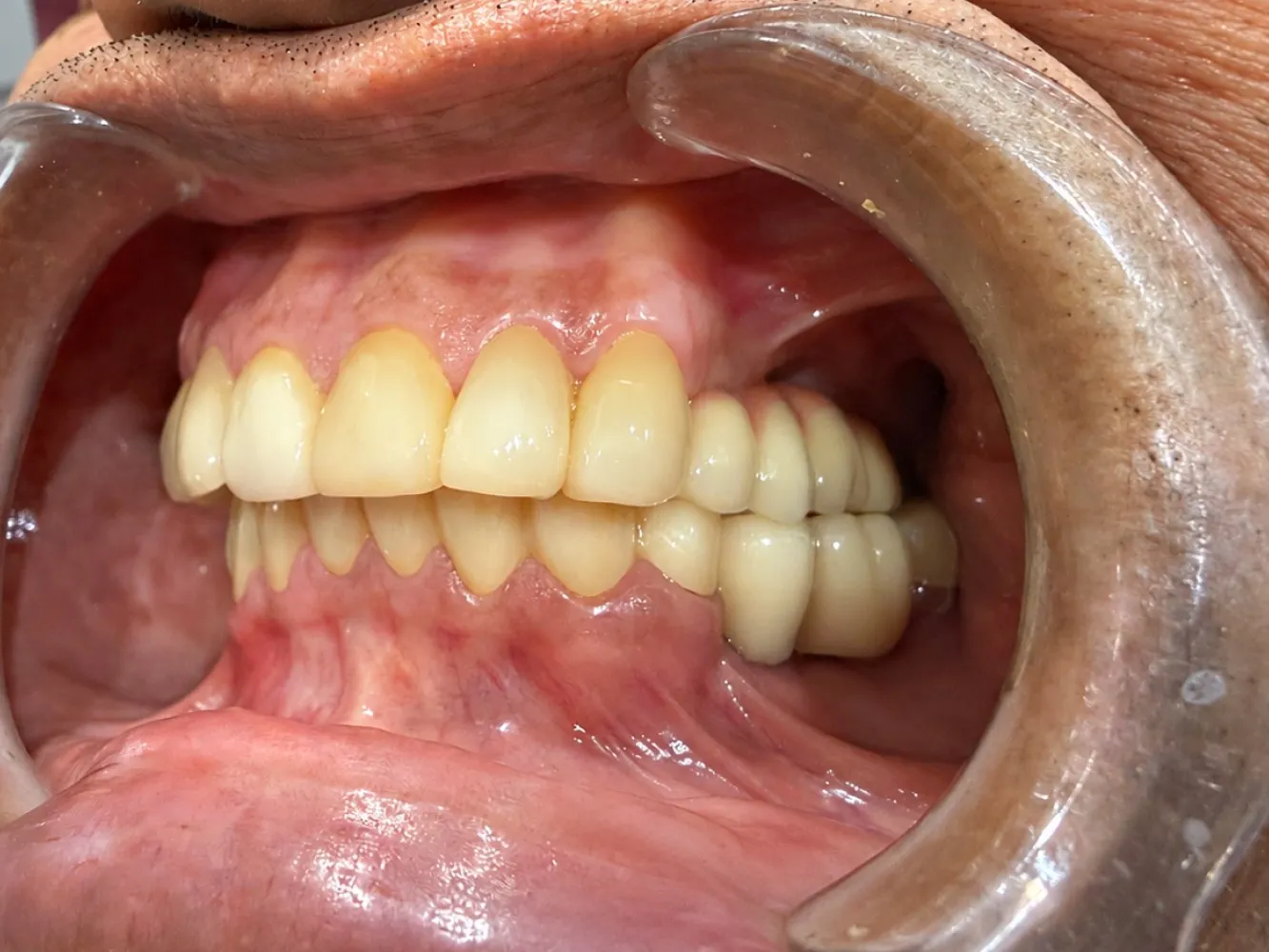 After: Right side, Case 1 · Full-Mouth Rehabilitation