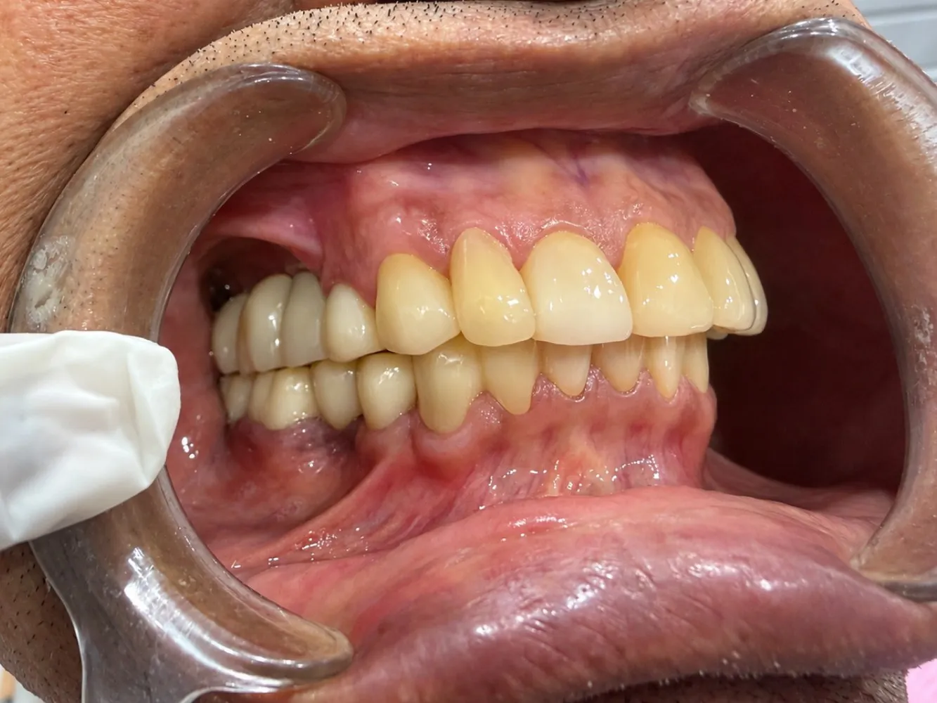 Before: Left side, Case 1 · Full-Mouth Rehabilitation