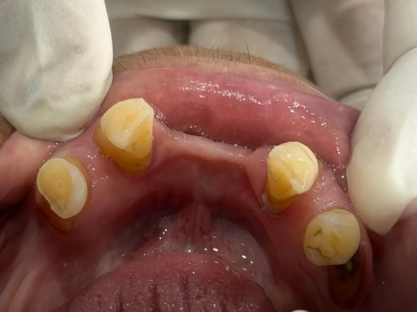 Before: Lower jaw, Case 2 · Full-Mouth Rehabilitation