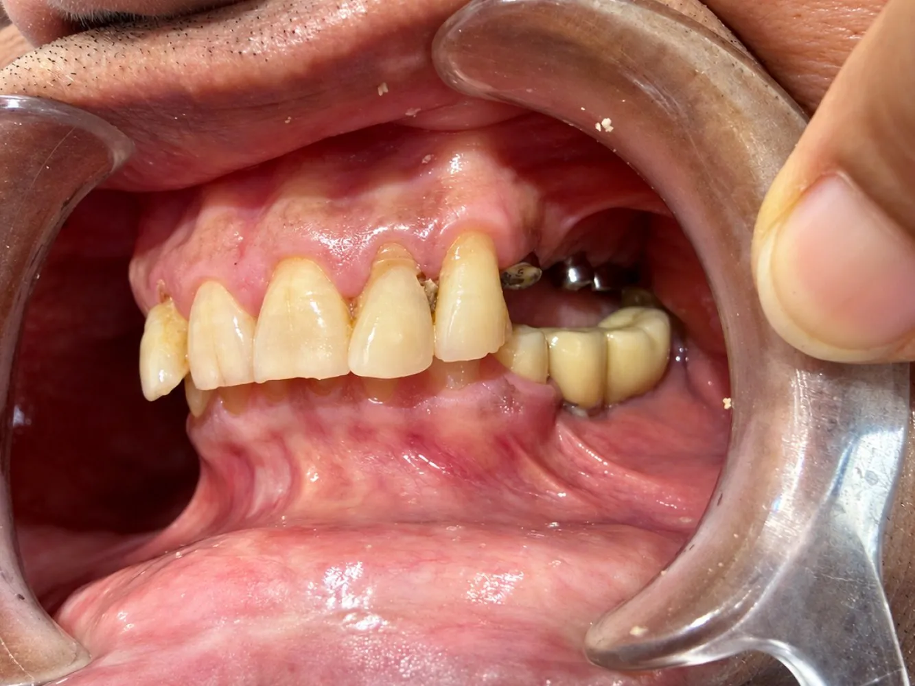 Before: Right side, Case 1 · Full-Mouth Rehabilitation